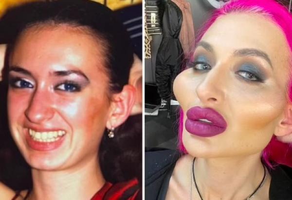 تنفق مبلغا ضخما على عمليات التجميل لتصبح صاحبة اكبر وجنتين بالعالم